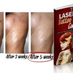 The Laserless Tattoo Removal Guide Review