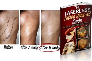 The Laserless Tattoo Removal Guide Review